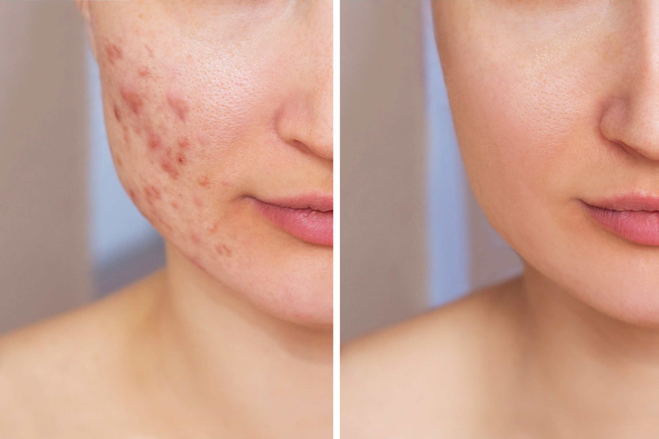 Acne Scar Treatment