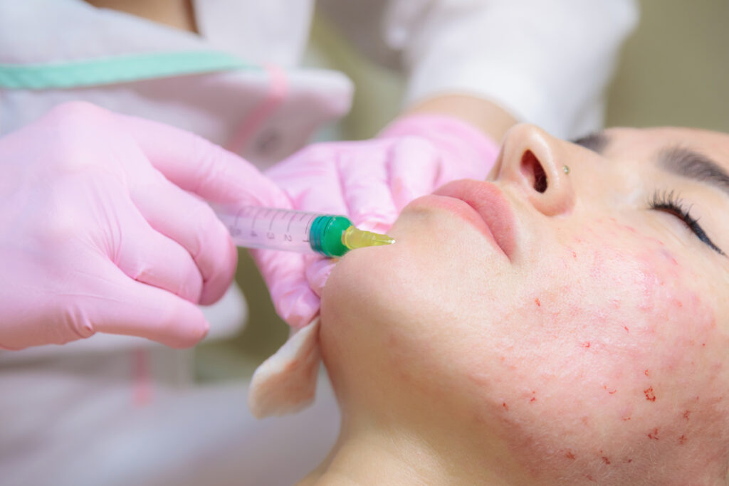 Acne Scar Treatment