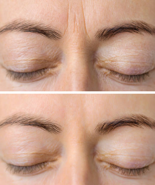 best botox treatment in kolkata