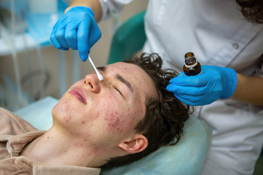 Acne Scar Treatment in Kolkata