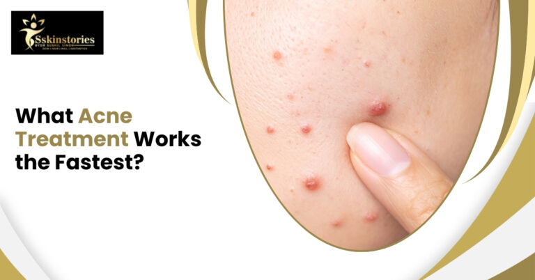 Acne Treatment